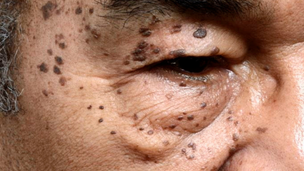 dermatose