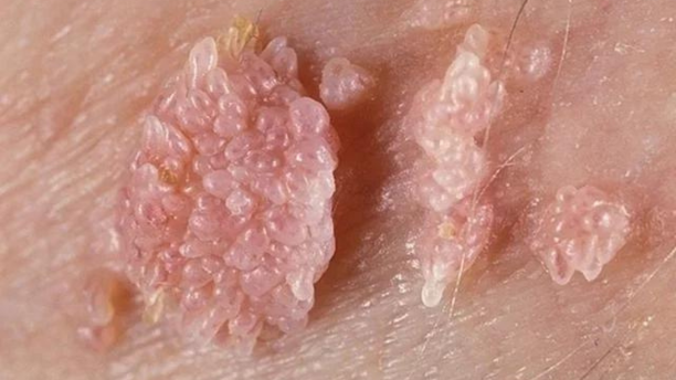 verruga hpv