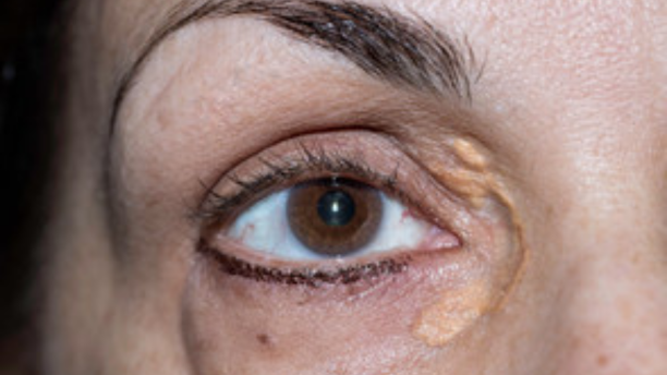 xantelasma